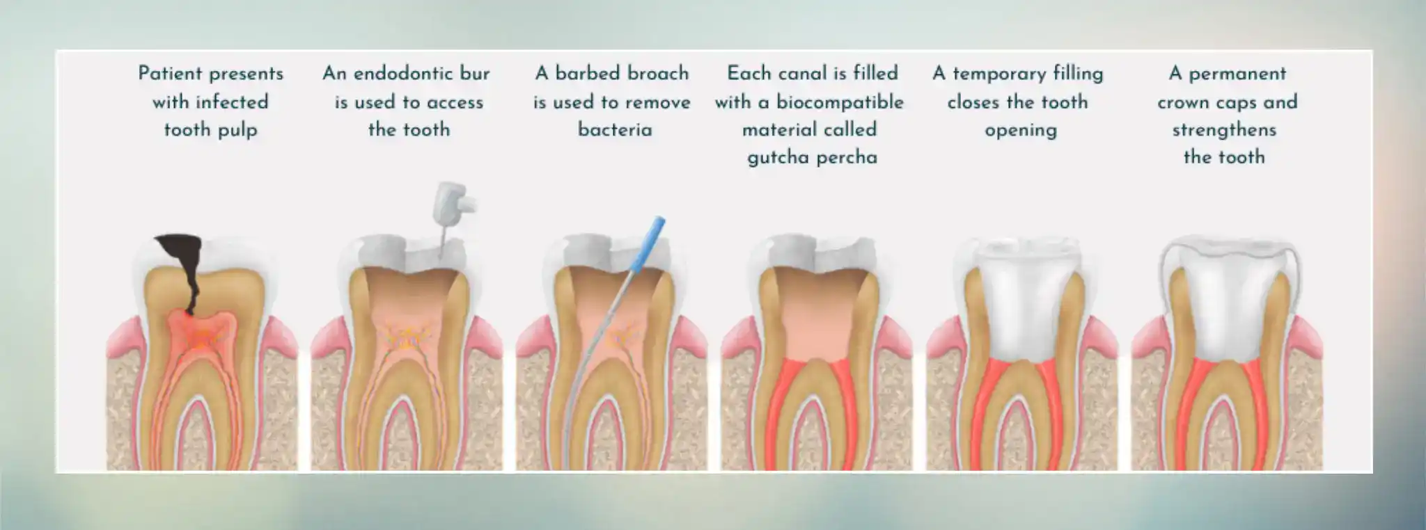 Root Canal Treatment In Gurgaon